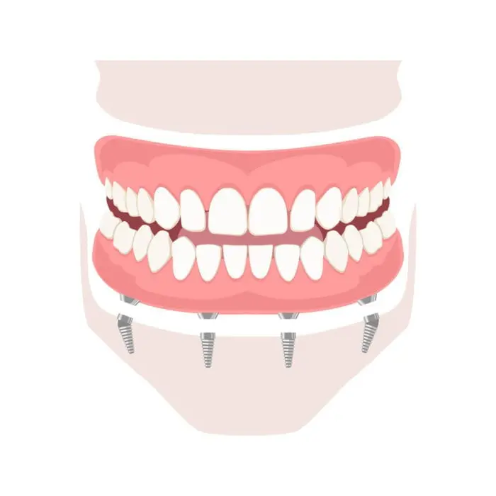 hybrid-dentures-treatment-near-me