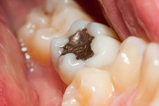 Dental Decay or Cavities