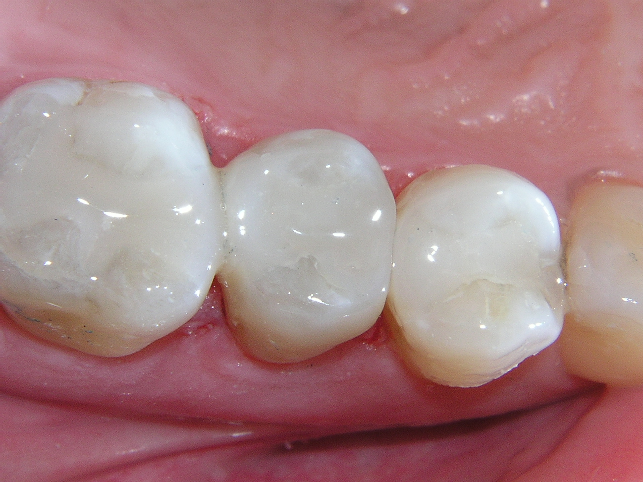 Composite Fillings