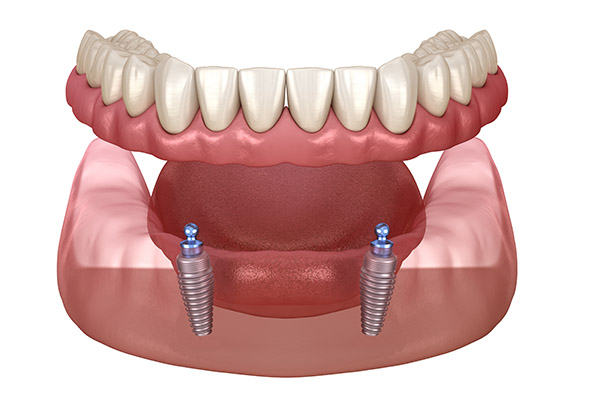 implant-overdenture-options-replacing-missing-teeth