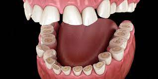 DENTAL BRUXISM