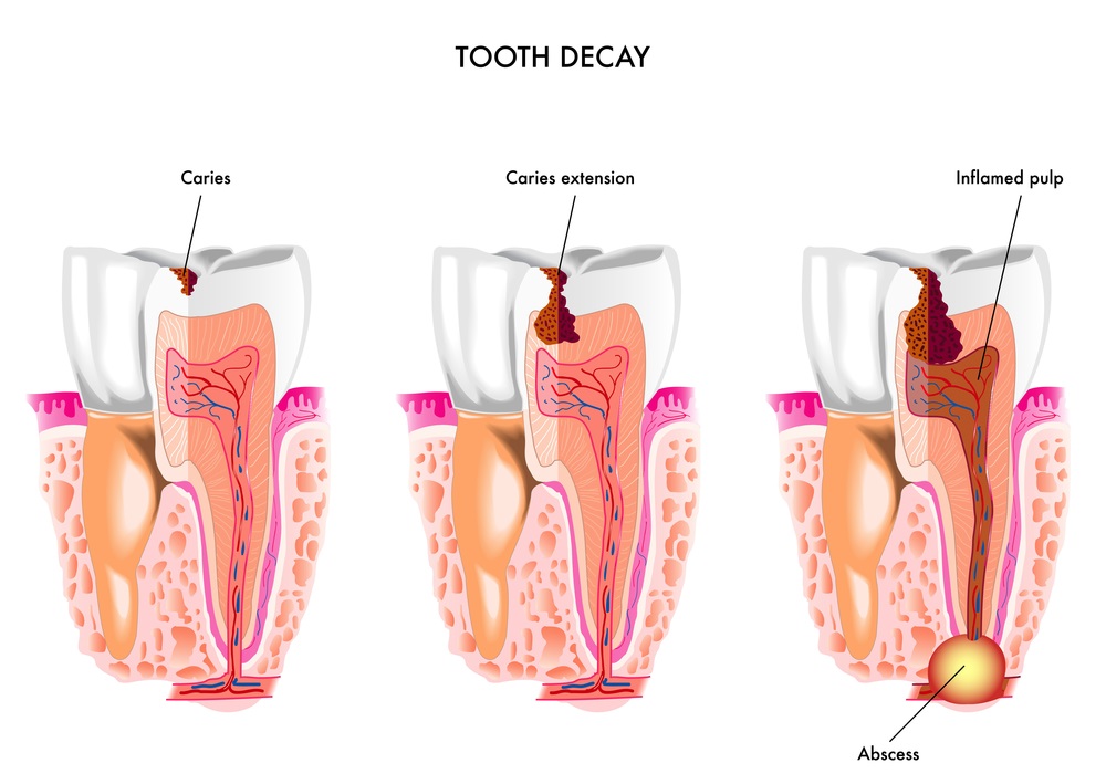 Dental Cellulitis