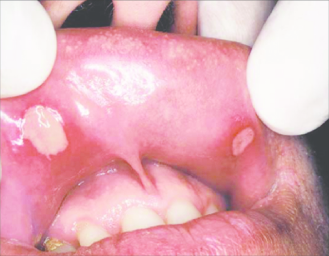 Aphthous Ulcers