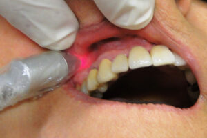 Low-level-laser-therapy-in-dentistry
