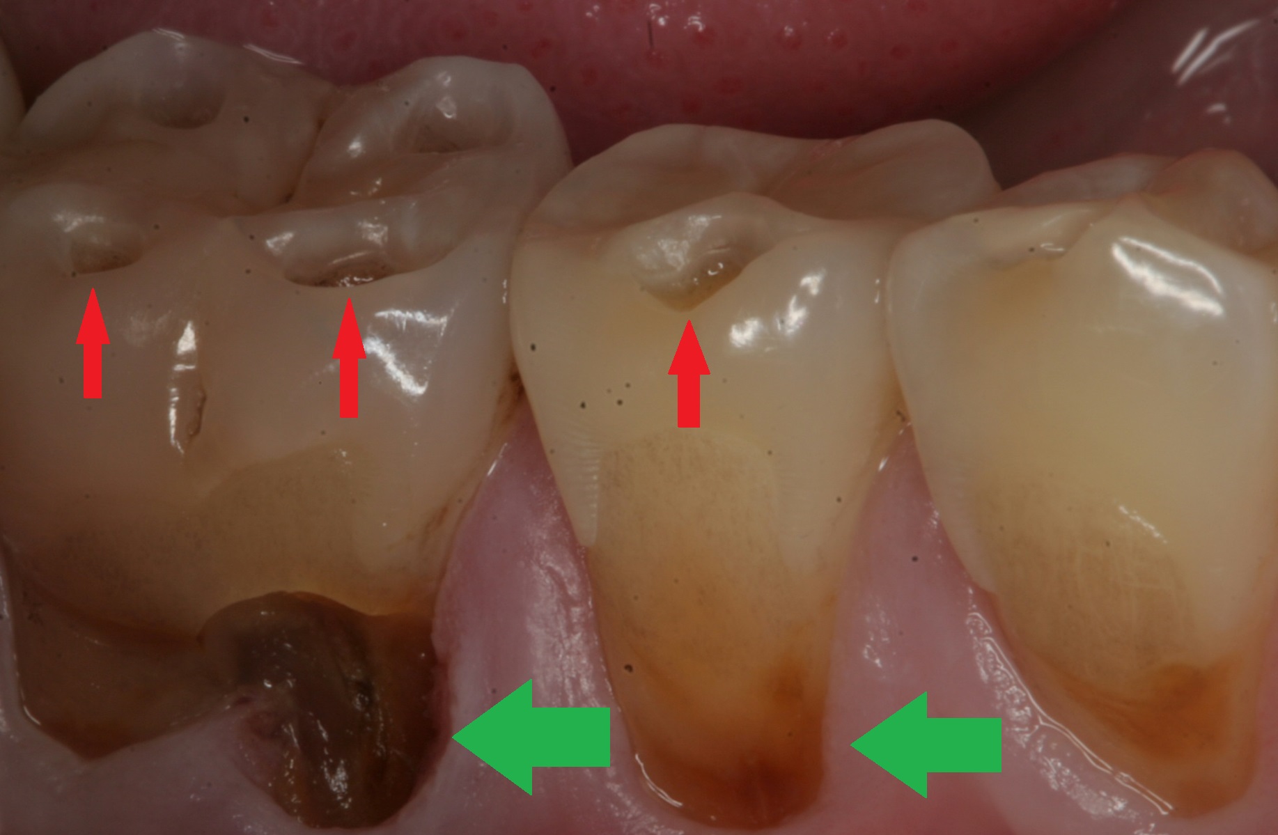 GERD Dental Erosions