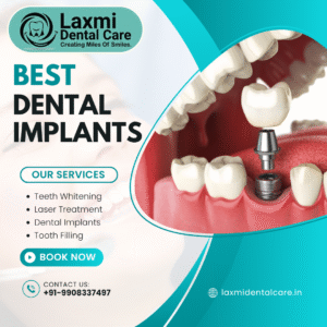 Read more about the article Dental Implants in Hyderabad.