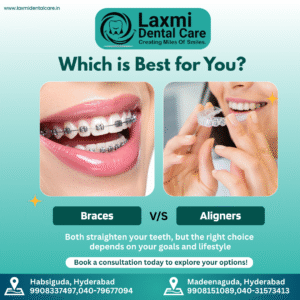 Read more about the article Best dental braces treatment in Hyderabad