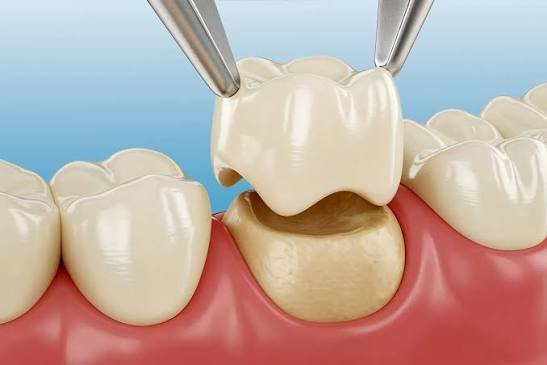 Read more about the article Best Zirconia Crowns Doctors Near Habsiguda, Hyderabad