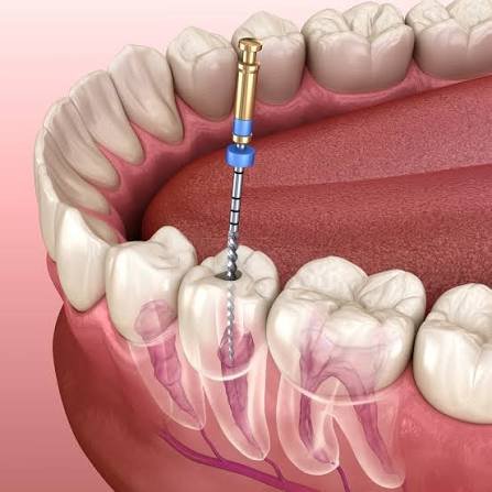 Read more about the article Best Root Canal Doctors Near me in Habsiguda, Hyderabad